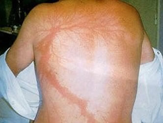 derdegraads brandwond bliksem derdegraads brandwond bliksem
